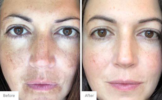 10 - Before and After Real Results photo of a woman's face.